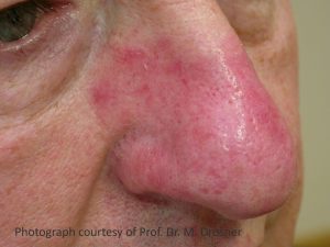 Skin redness reducion belfast