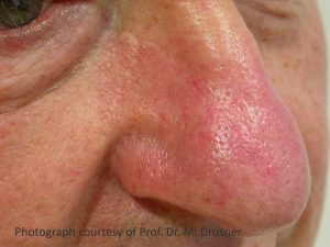 Skin redness reducion northern ireland